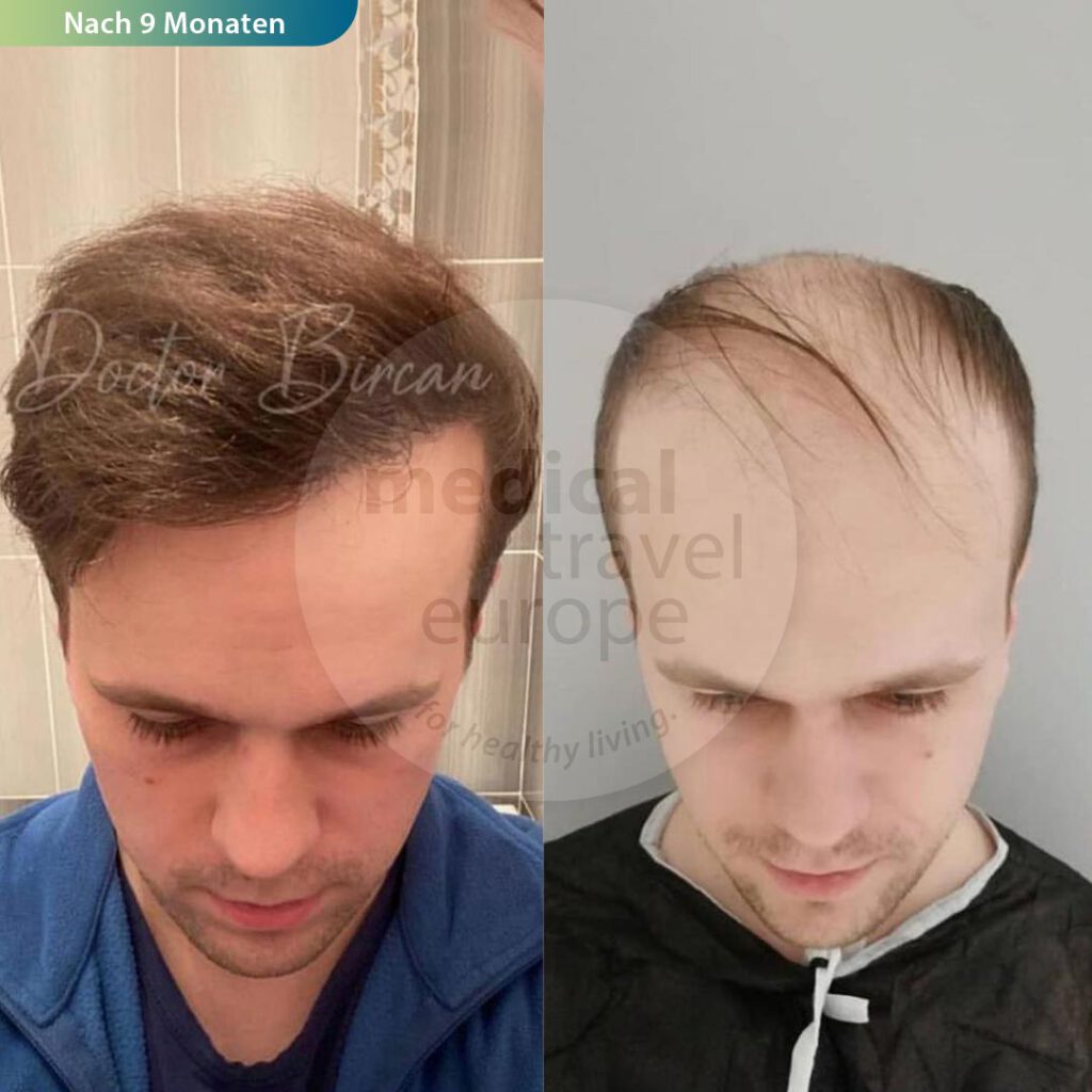 hair transplant