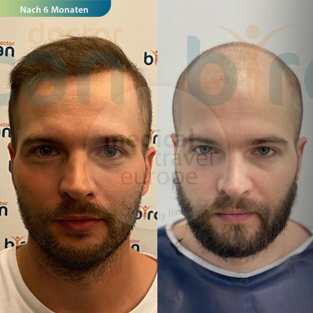 hair transplant